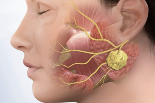 Biopsia de Glándula Salival menor